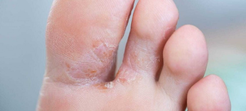 Secar bem entre os dedos dos pés após o banho é uma medida de prevenção
